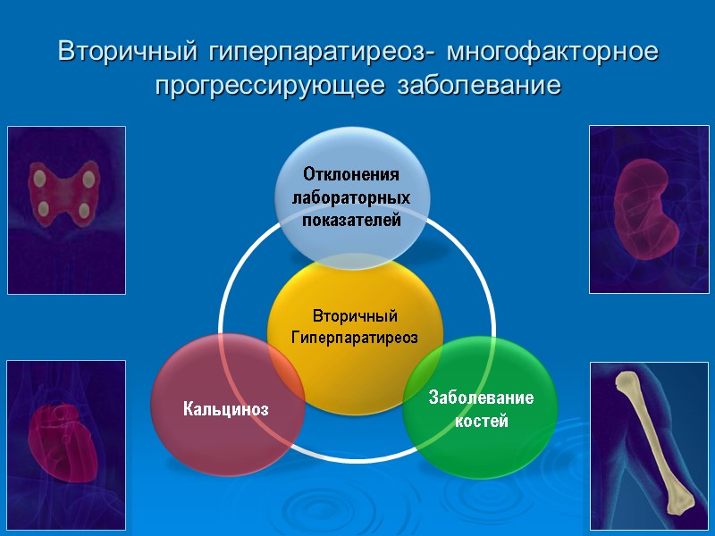 Вторичный гиперпаратиреоз- многофакторное прогрессирующее заболевание